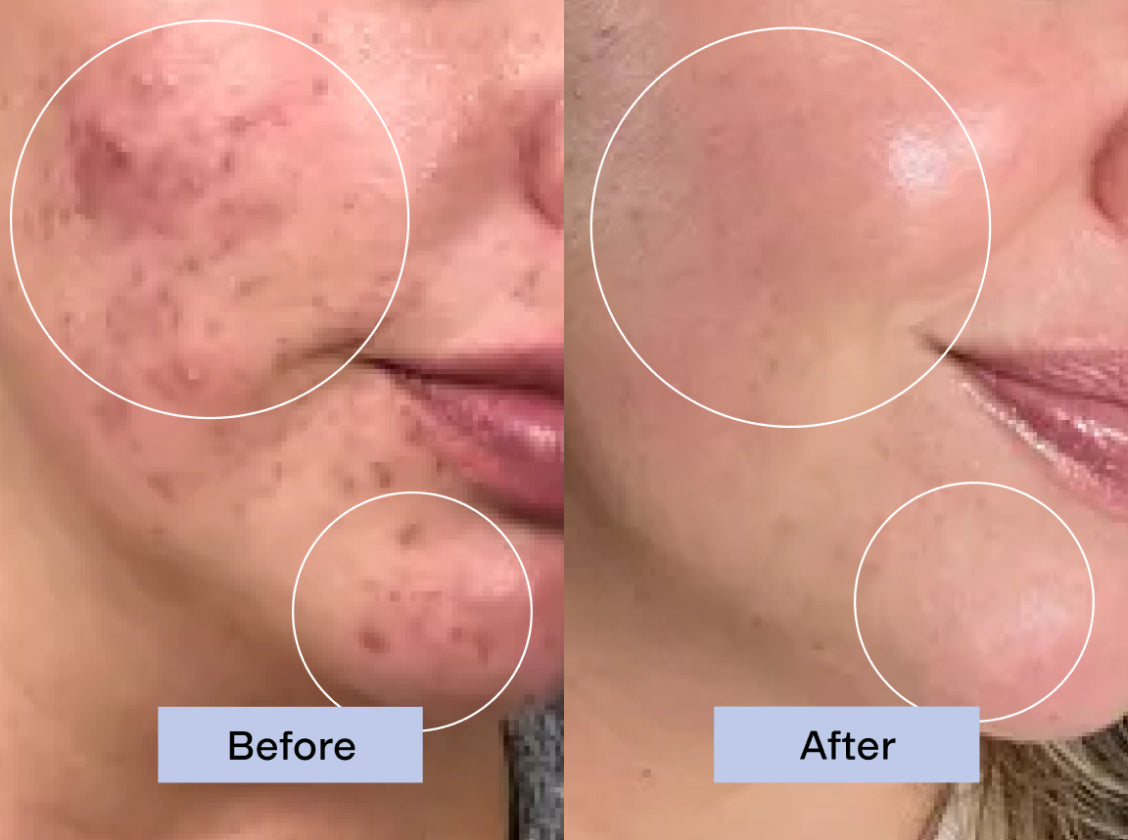 Before and after comparison of skin cleared with MINDBODYSKIN®