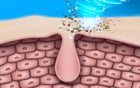 How to Clear and Prevent Cystic Acne