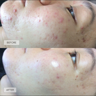 How Lynn Cleared Her Acne and Dark Spots