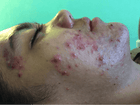 Cystic Acne Advice