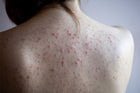 Get Rid of Back Acne & Scars Naturally